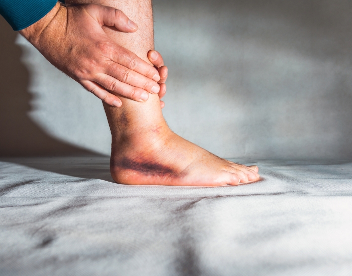 Link Between Fluid Retention and Heart Health Swollen Legs and Heart Problems