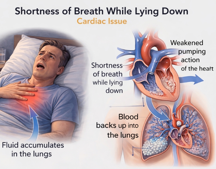Shortness of Breath When Lying Down: Could It Be a Sign of Heart Failure?