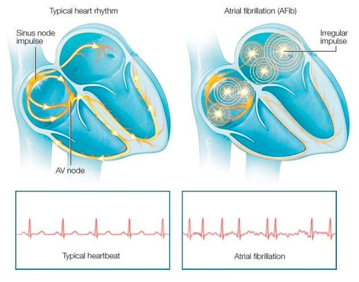 paroxysmal atrial fibrillation is paroxysmal AFib dangerous